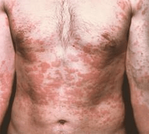 La piel problemática es un síntoma de presencia de parásitos