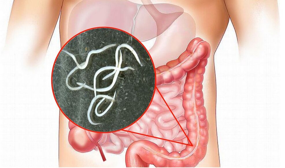 Hay gusanos en los intestinos.